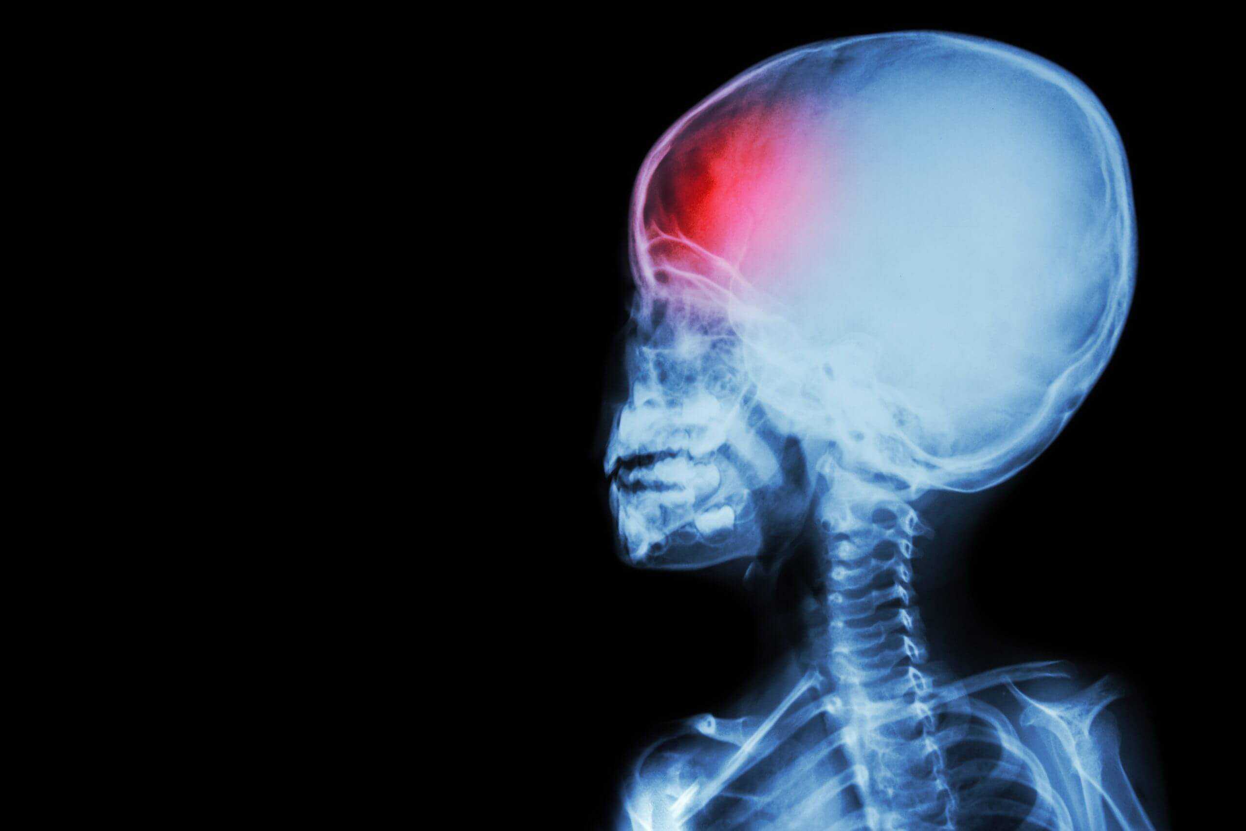 Signs You May Have Suffered a Brain Injury scaled