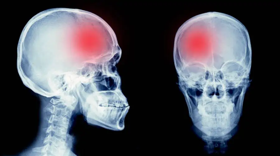 Brain Injury Compensation Claims Hollywood thumbnail